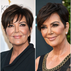 Before and after images of Kris Jenner showcasing her facial transformation.